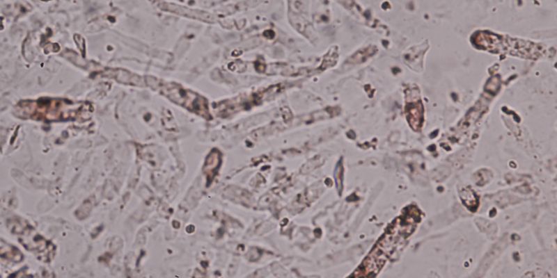 Why Understanding Hyaline Casts Is Important