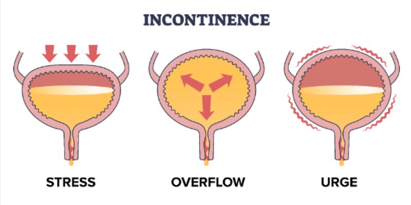 Does a Yeast Infection Cause Blood in Urine