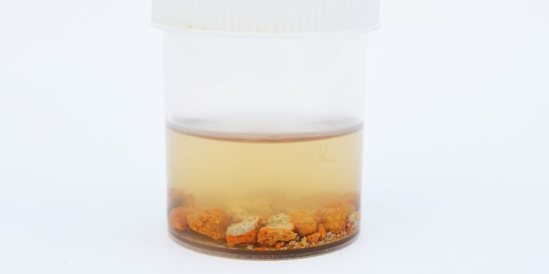 Types of Kidney Stones and Their Appearance