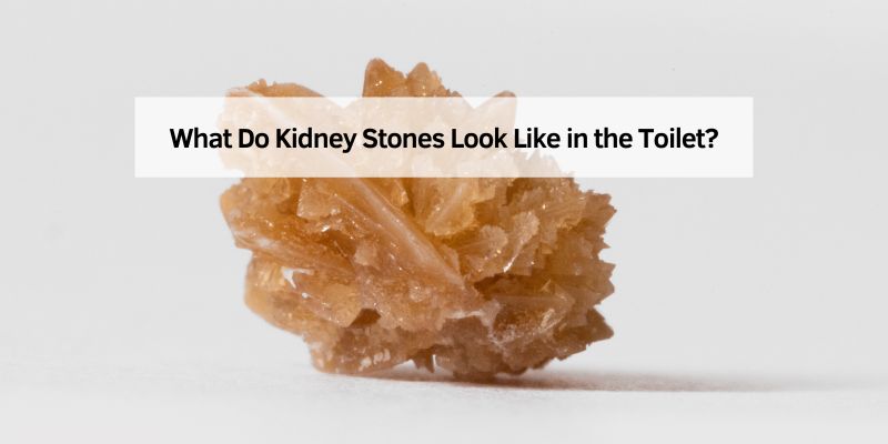 What Do Kidney Stones Look Like in the Toilet