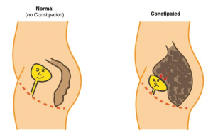 Does Constipation Cause Frequent Urination