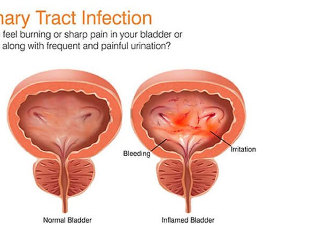 Why Does It Hurt When I Urinate