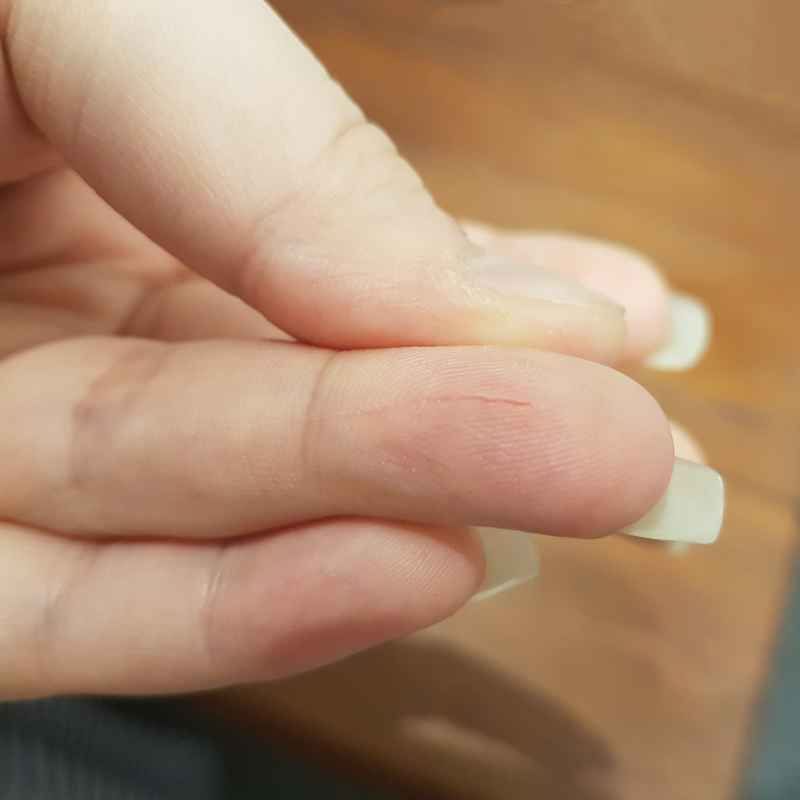 What Happens When You Use Super Glue on a Cut?